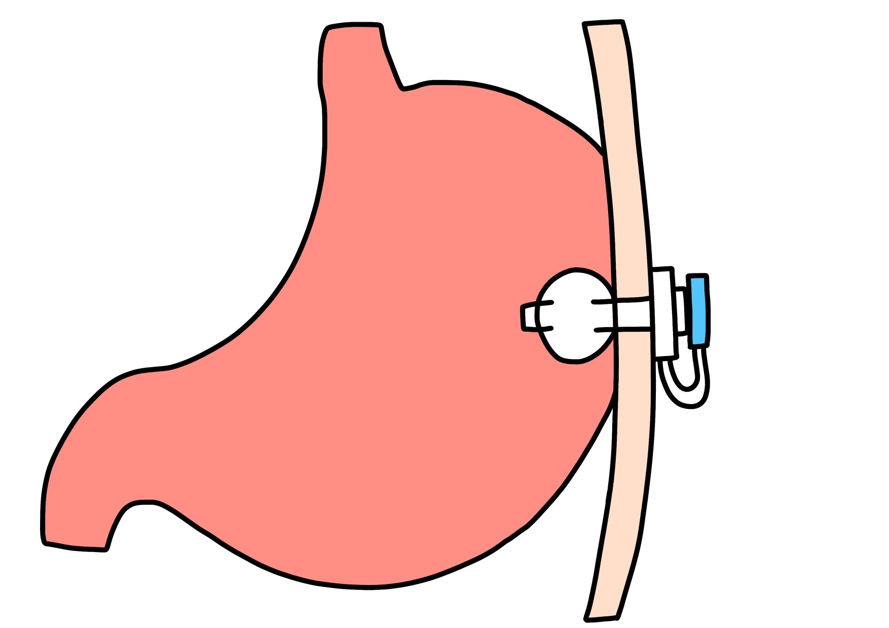 経皮内視鏡的胃瘻造設術(PEG)